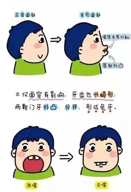 腺样体肥大睡觉姿势图图片