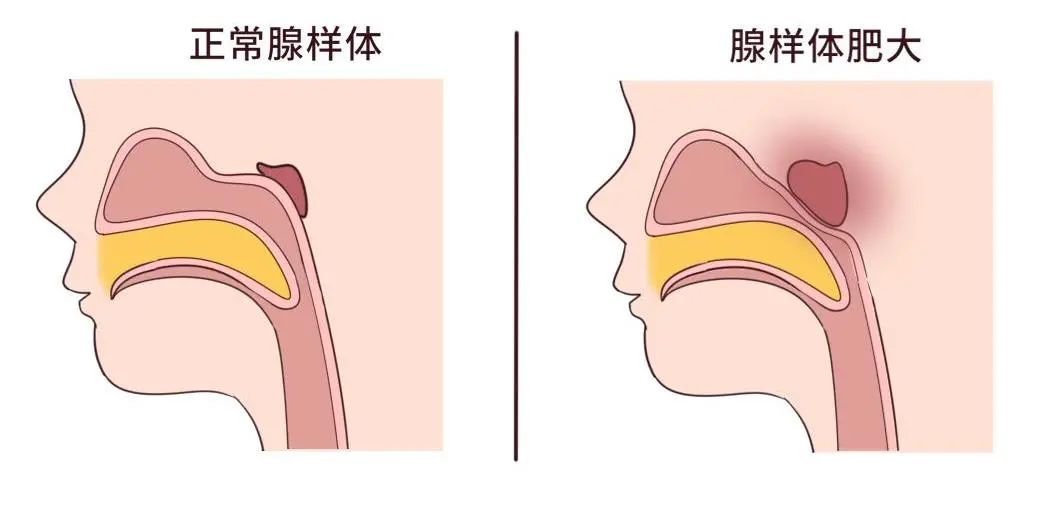 科普常识孩子睡觉打鼾小心腺样体肥大还影响颜值和智力