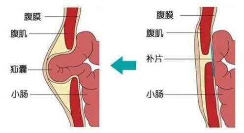 腹股溝疝,俗稱疝氣,是由於腹股溝區出現薄弱或缺損,腹腔內的臟器,如