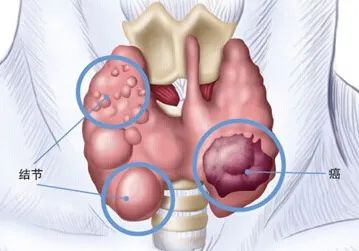 甲状腺结节照片图图片