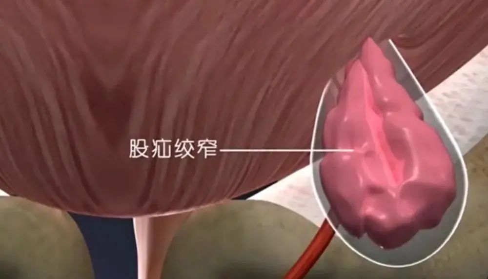 醫療資訊小切口高療效腹腔鏡下腹股溝疝修補微創手術