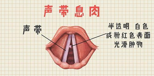 什麼是聲帶息肉?