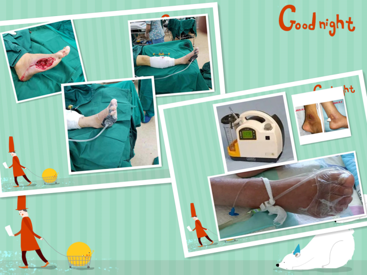 简篇-天气转冷,糖足多发,如何严防糖足反扑,一文带你了解糖尿病足。 图片