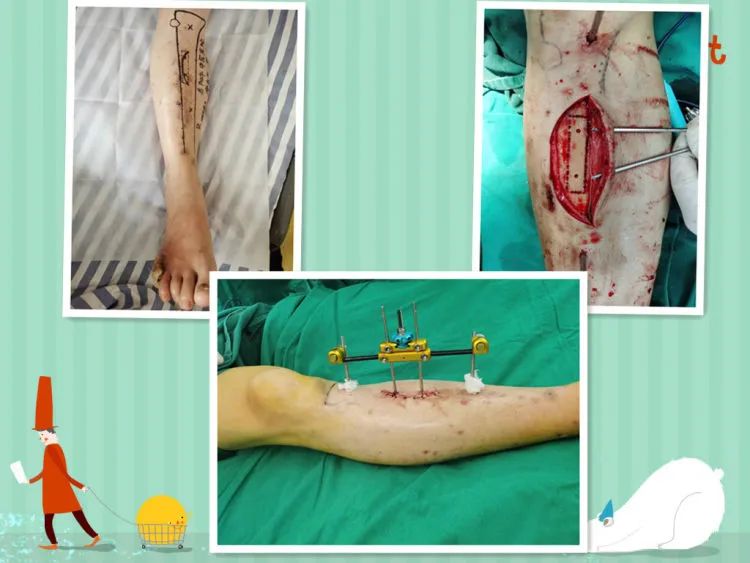 简篇-天气转冷,糖足多发,如何严防糖足反扑,一文带你了解糖尿病足。 图片