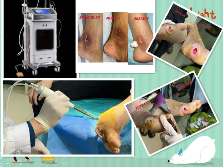 简篇-天气转冷,糖足多发,如何严防糖足反扑,一文带你了解糖尿病足。 图片