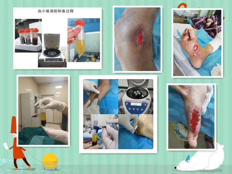 简篇-天气转冷,糖足多发,如何严防糖足反扑,一文带你了解糖尿病足。 图片