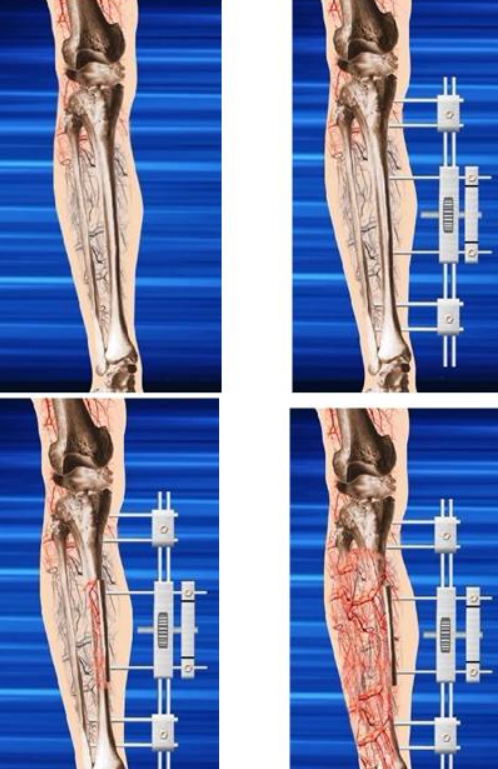 简篇-天气转冷,糖足多发,如何严防糖足反扑,一文带你了解糖尿病足。 图片