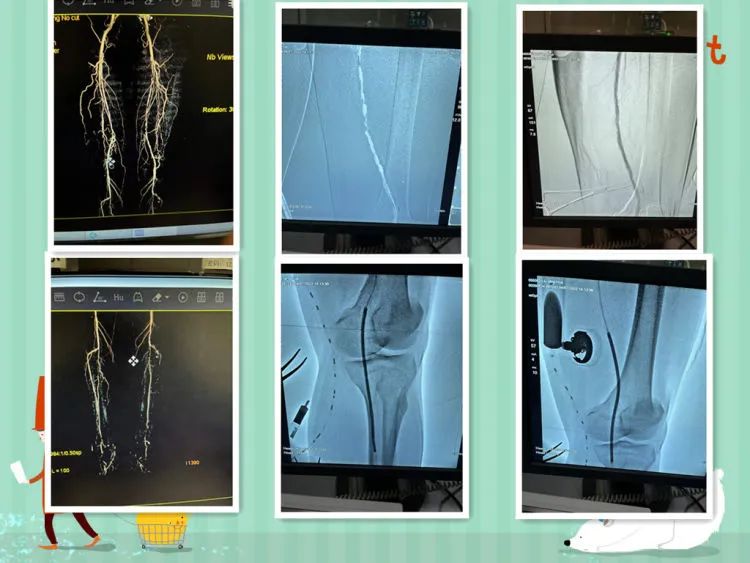 简篇-天气转冷,糖足多发,如何严防糖足反扑,一文带你了解糖尿病足。 图片