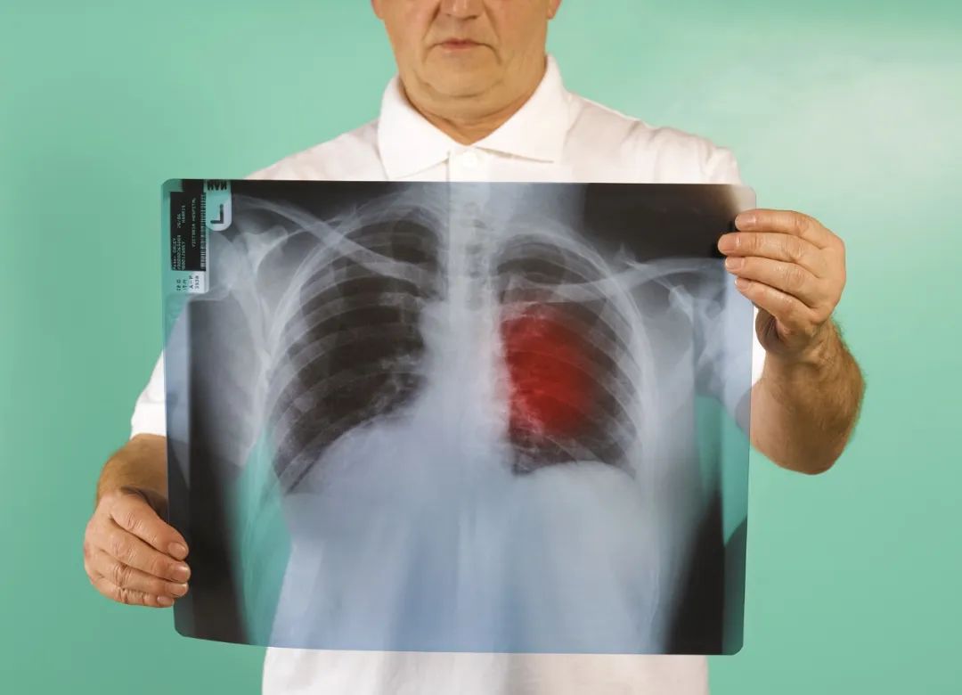 女性肺癌早期症状图片图片