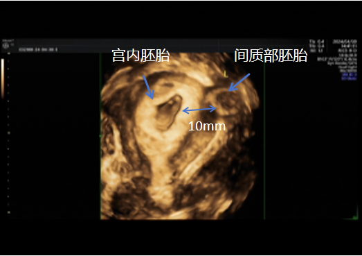 宫角妊娠图片 彩超图片