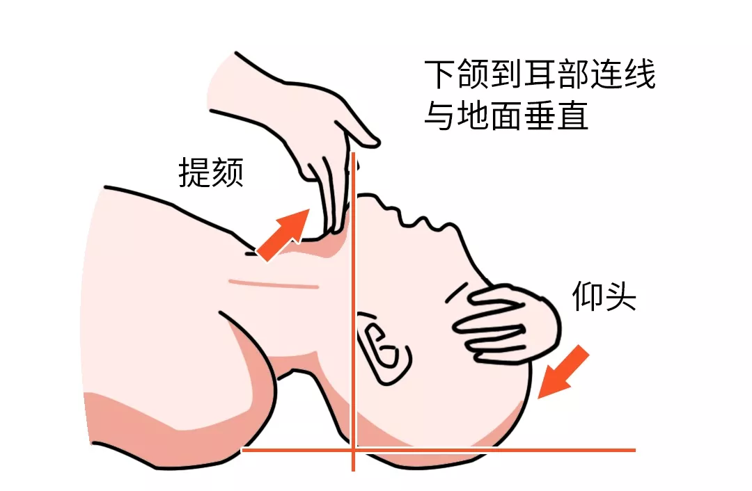 在黄金四分钟实施心肺复苏术