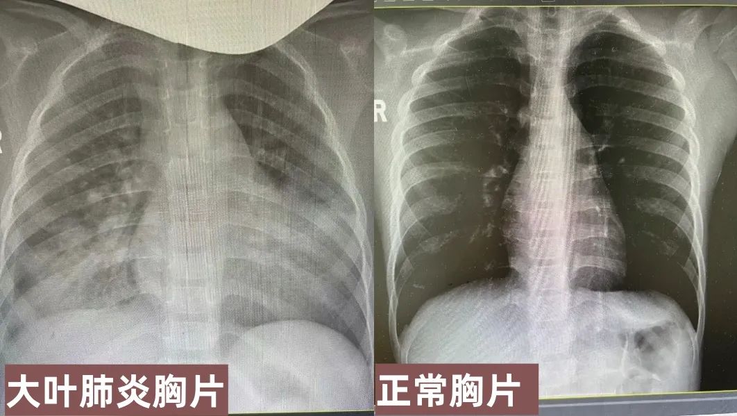 大叶性肺炎dr图片图片