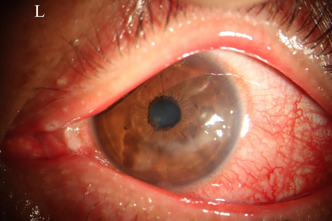 这是感染单纯疱疹病毒引起的病毒性角膜炎的表现