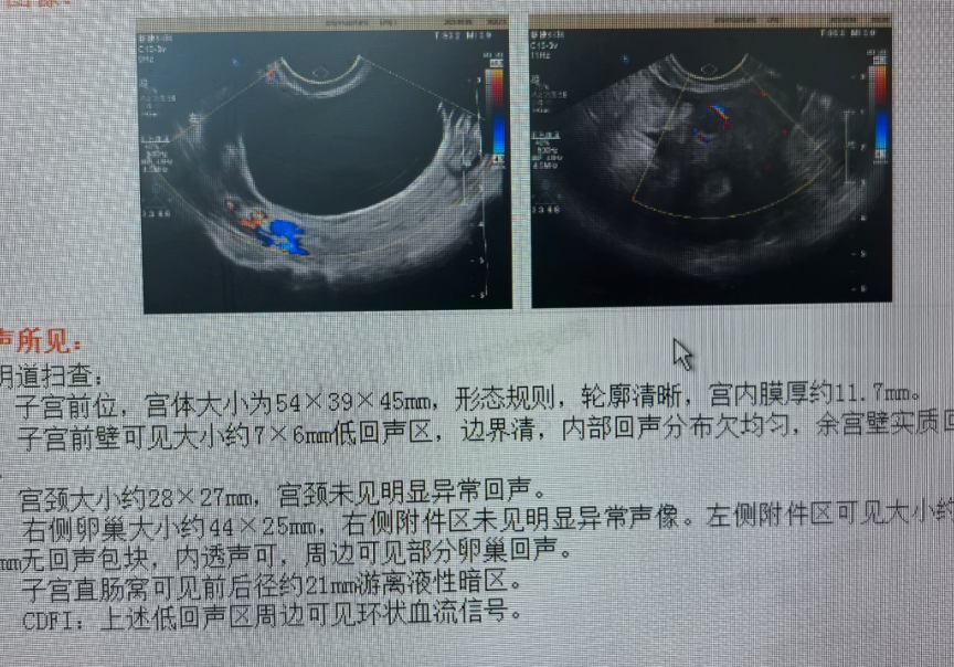 近6厘米囊肿，不开刀，8个月消失了？